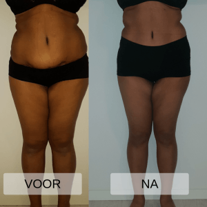 Voor en na foto bodysculpting Total Body Salon